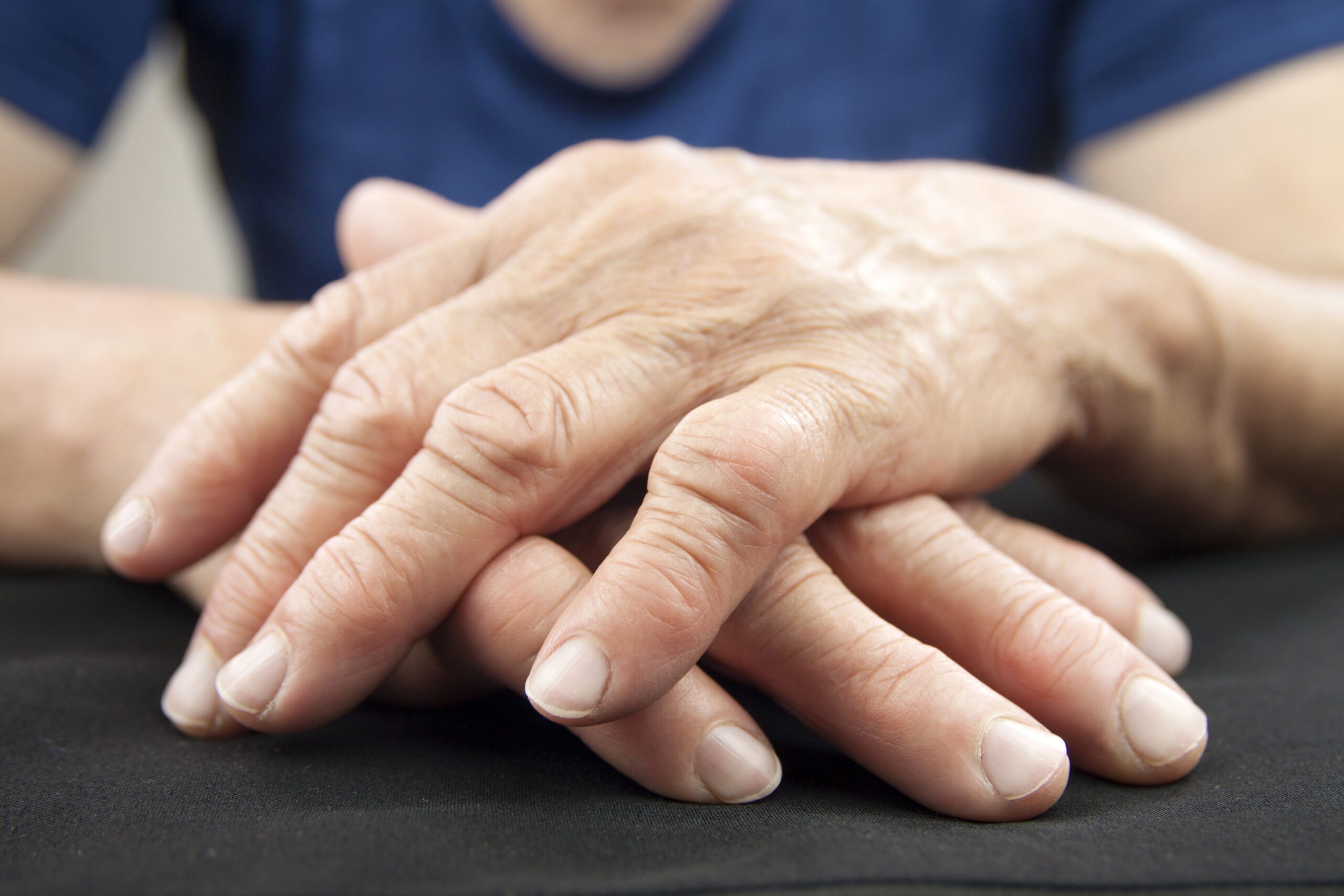 Patient with deformed hands from rheumatoid arthritis before hand arthritis surgery