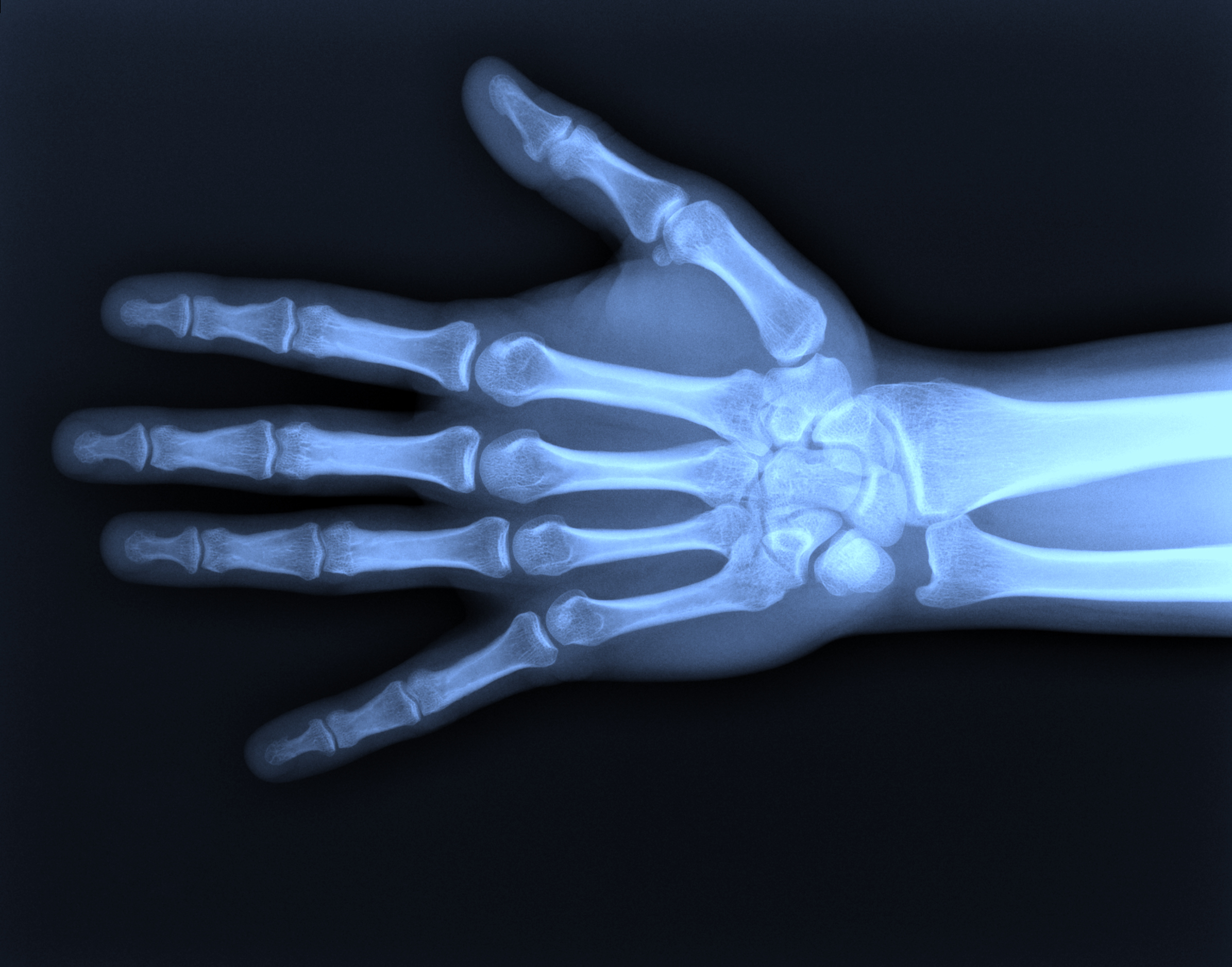 Hand fractures, x-ray of the hand
