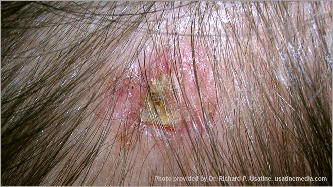 What basal cell carcinoma looks like