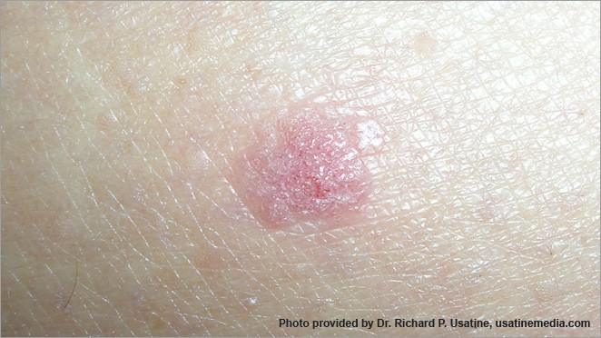 What basal cell carcinoma looks like