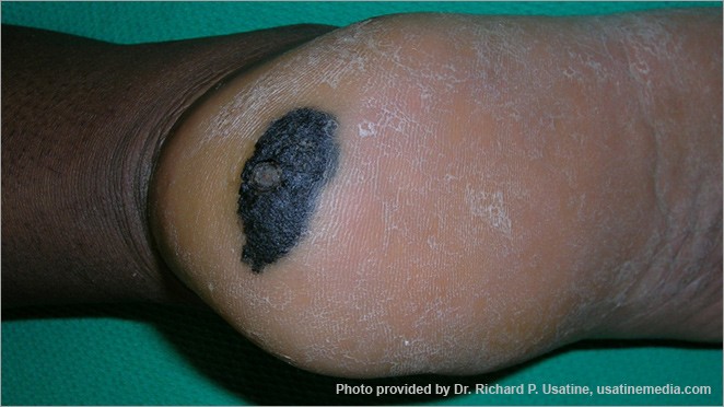 What melanoma looks like