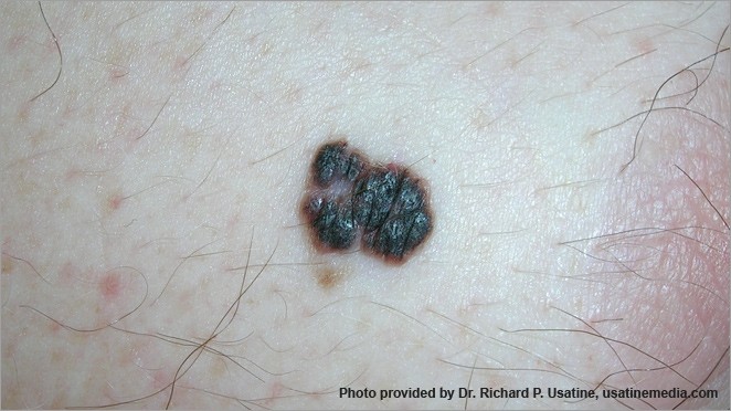 What melanoma looks like