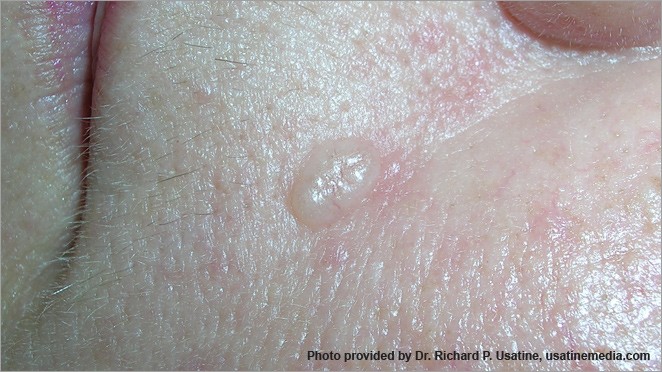What squamous cell carcinoma looks like