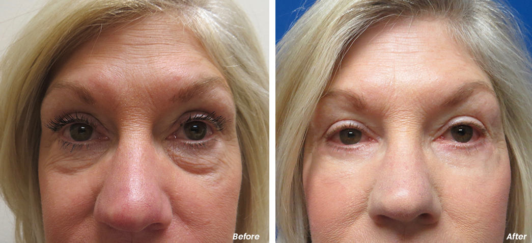 Before and after lower blepharoplasty