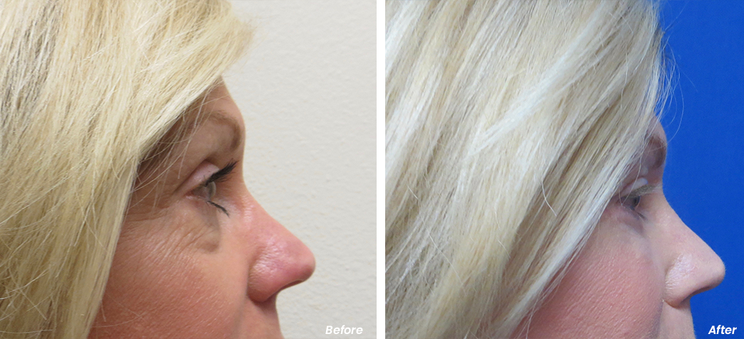 Before and after lower blepharoplasty