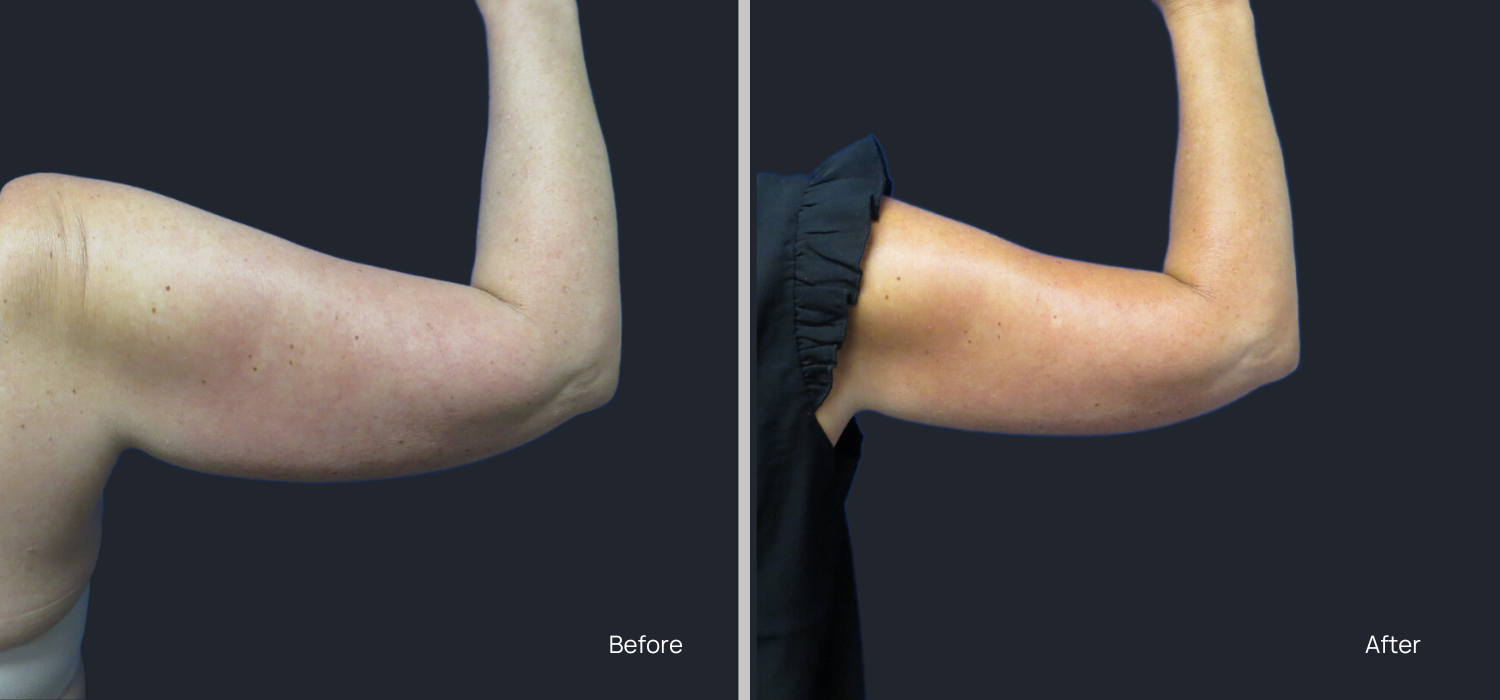 Before and After Arm CoolSculpting