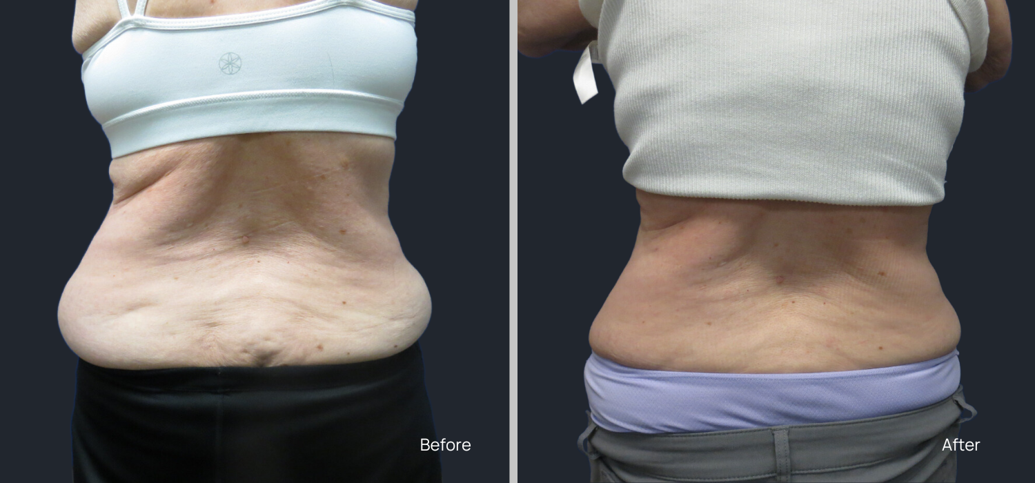 Abdominal CoolSculpting Before and After