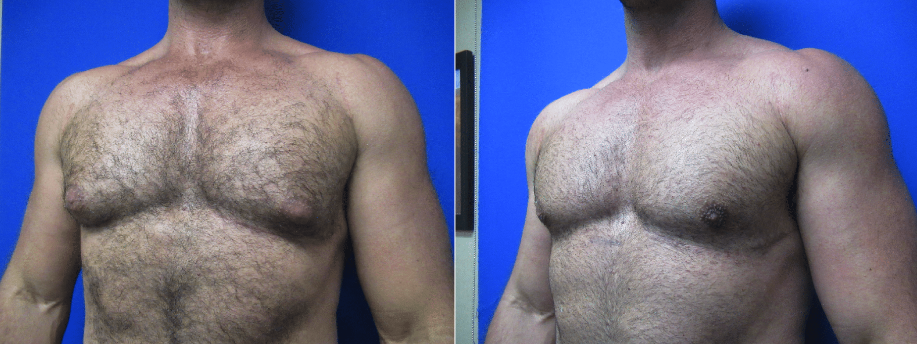 Gynecomastia Before and After by Dr. Adam Boettcher in Flagstaff