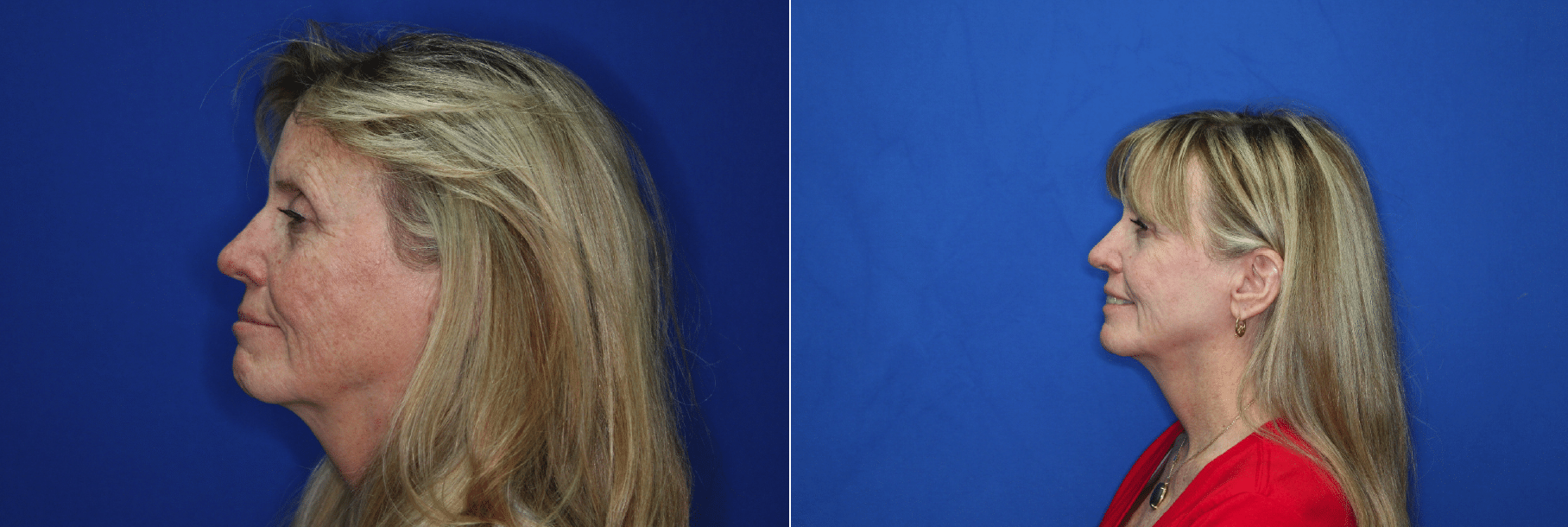 Full Face CO2 laser by Dr. Brian Cripe in Flagstaff