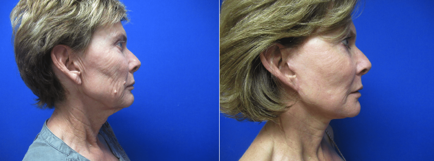Facelift, fat. grafting, upper bleph, brow lift, and CO2 laser by Dr. Adam Boettcher in Flagstaff