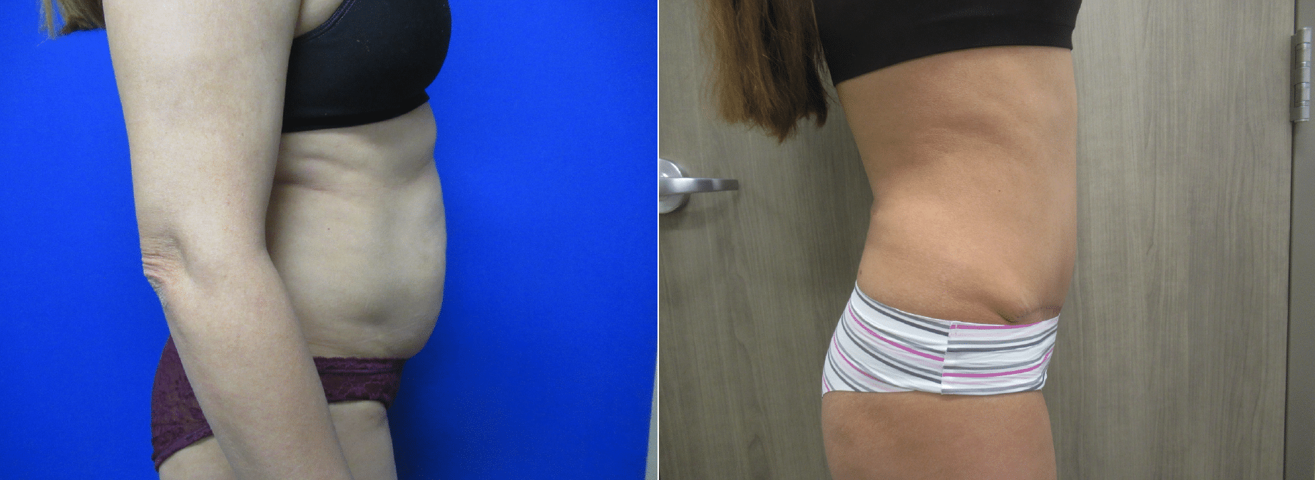 Abdominoplasty by Dr. Adam Boettcher