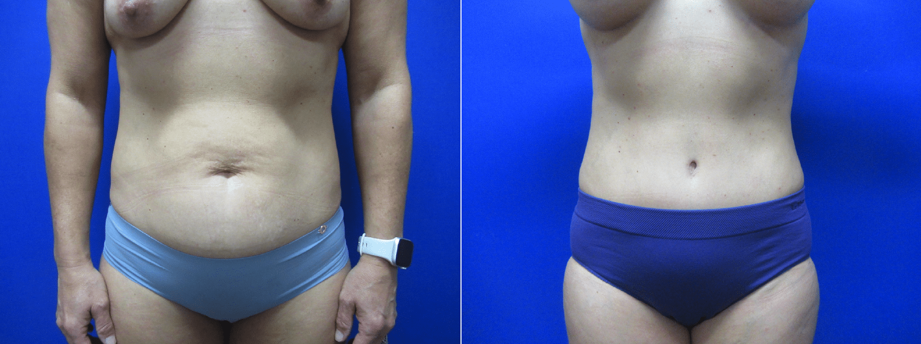 Mommy makeover by Dr. Adam Boettcher